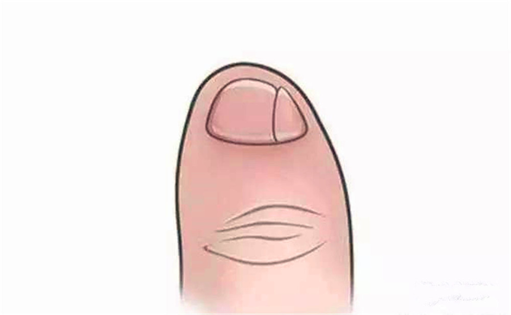 小脚趾指甲长成两瓣、三瓣的人，究竟是什么来历？有科学说法吗