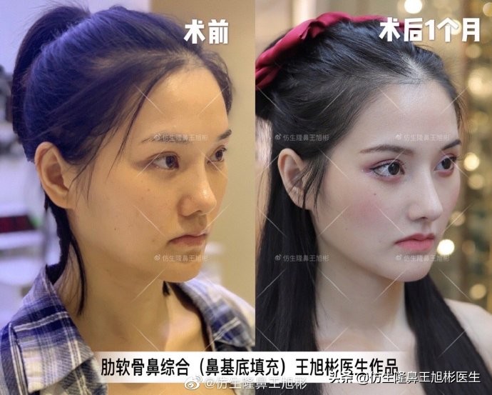 广州隆鼻科普：王旭彬鼻整形修复案例分享