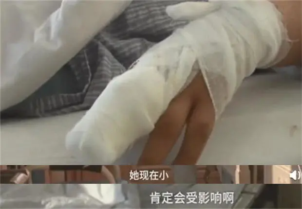 10个月女婴,被家人刮痧毁了脸
