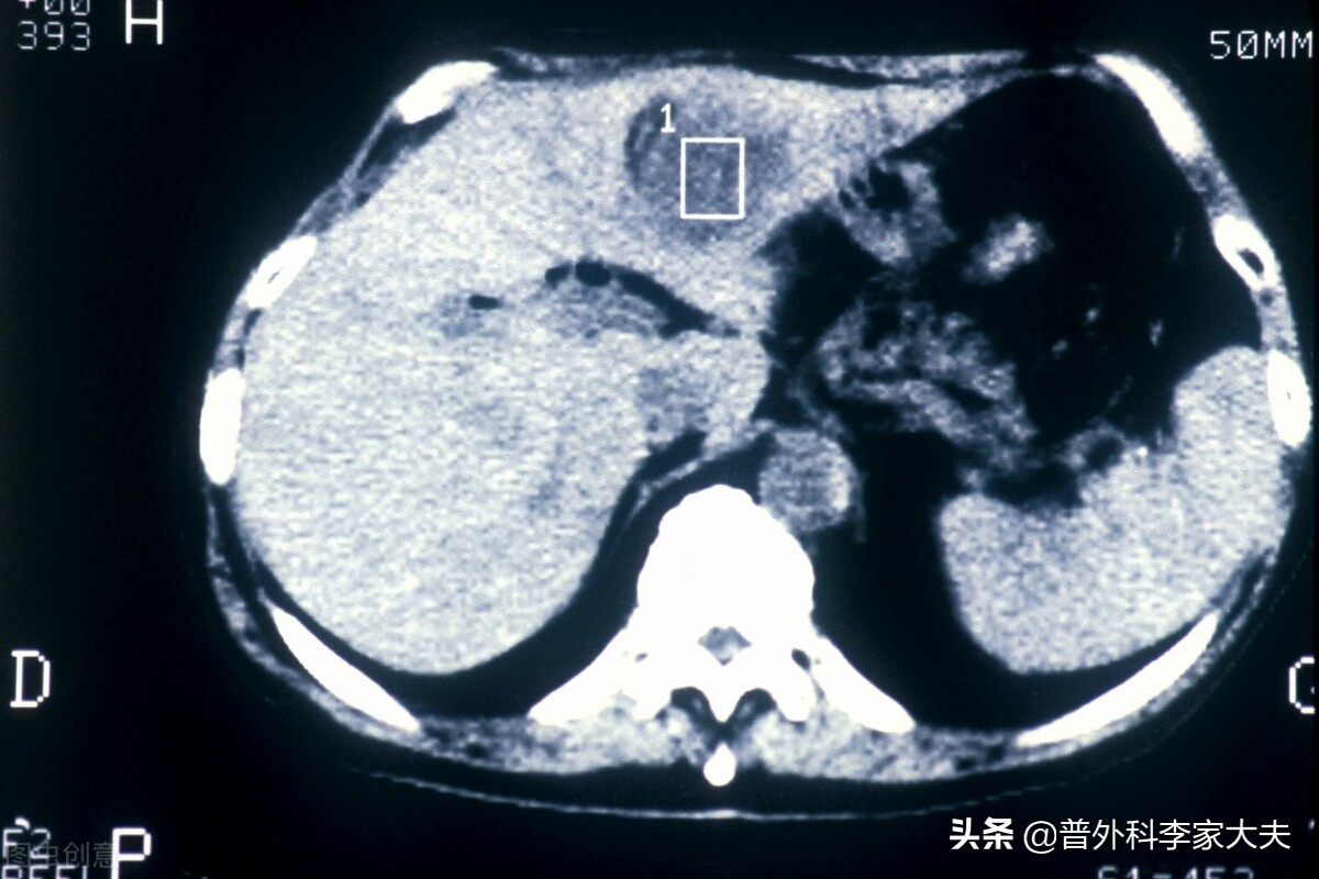 6cm大小的肝癌，该如何治疗？