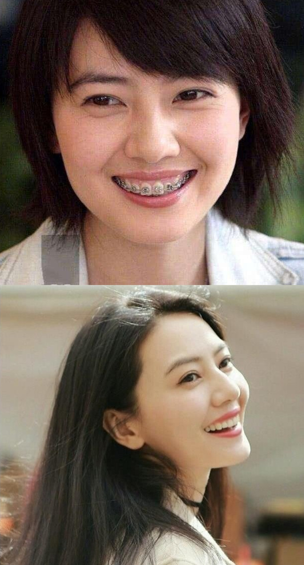 说刘亦菲牙齿丑的，是烤瓷牙看多了吧？