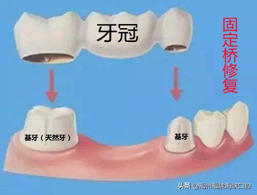 活动假牙活动假牙又叫活动义齿,活动假牙又有局部挂钩假牙和全口假牙