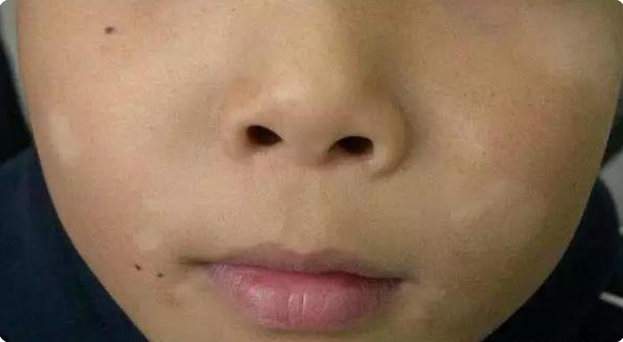 孩子脸上长白斑,先别着急"打虫",对症治疗很重要,以免娃自卑