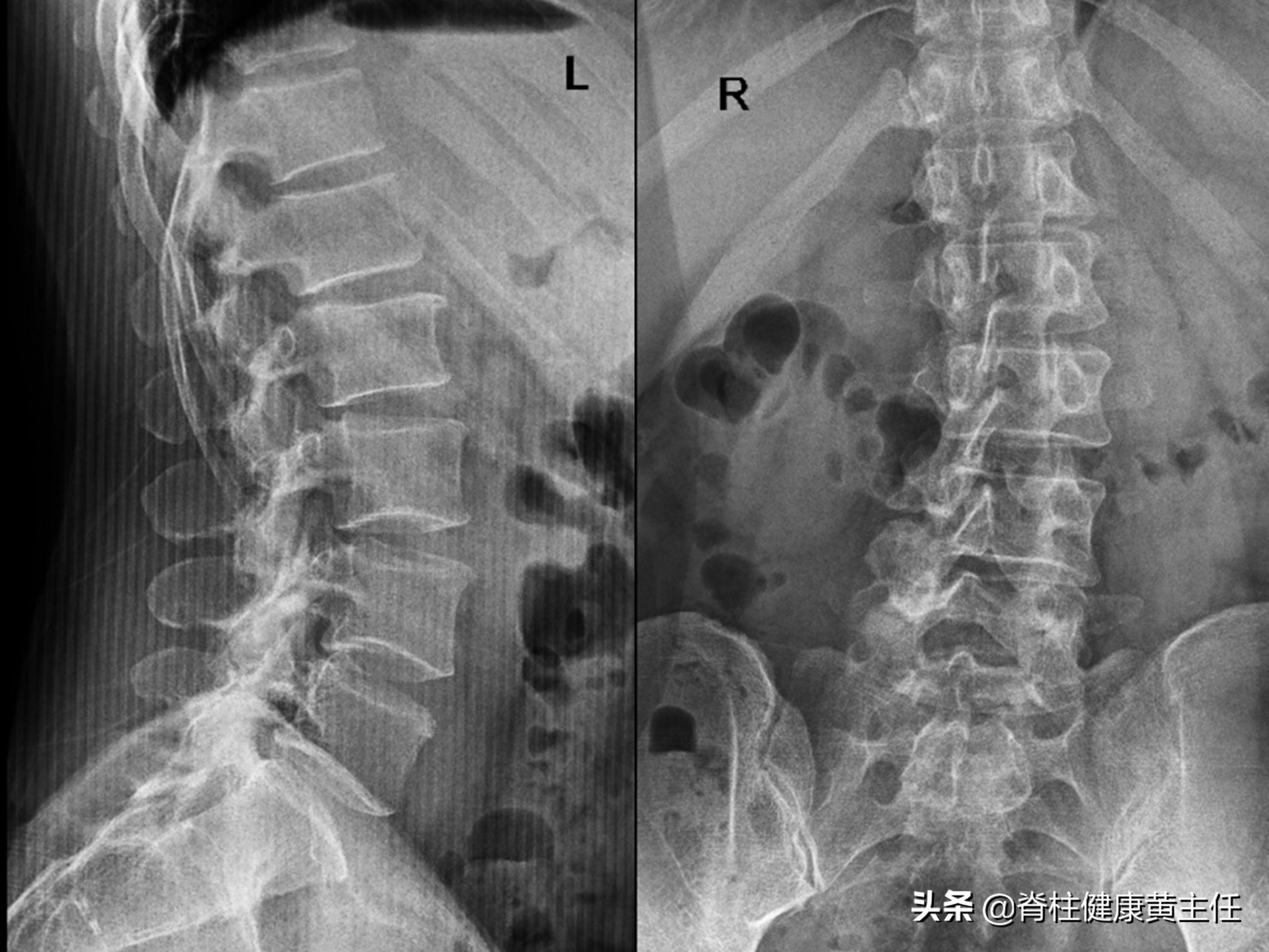腰痛不是椎间盘突出，也不是腰肌劳损，那会是什么原因？