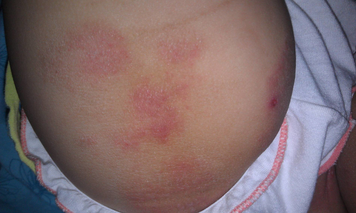 妈妈说,孩子1岁左右换奶粉的时候,发现他牛奶蛋白过敏,只能换成深度