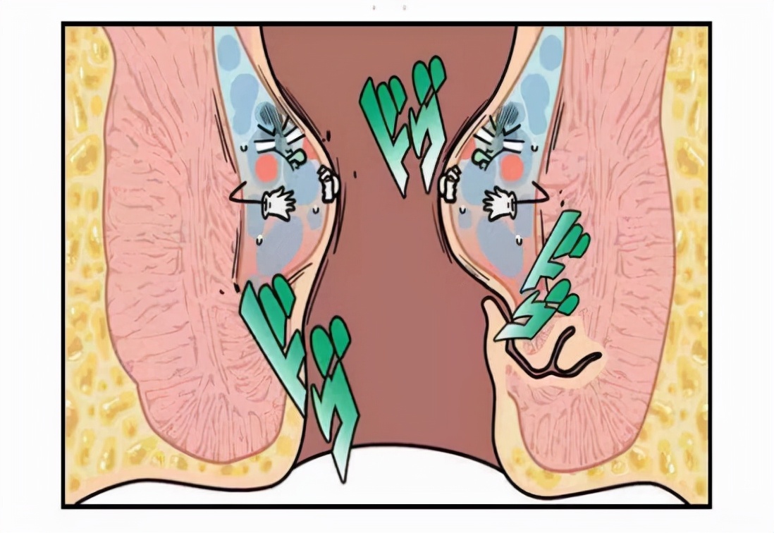 肛门潮湿、发痒且有分泌物，3种病因很常见，本文告诉你