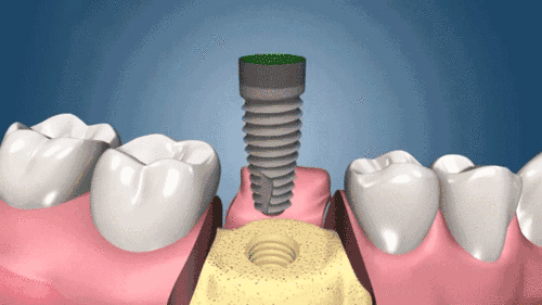 种植牙详细步骤图解(种植牙的流程有哪些？分为一二三期？)
