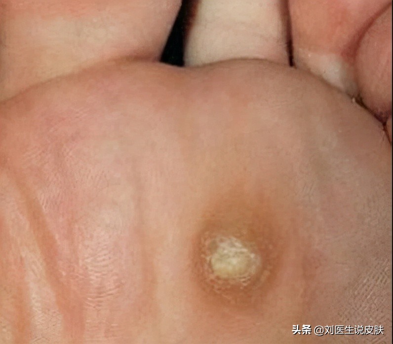 鸡眼与跖疣的区别诊断：如何正确识别这两种足部疾病