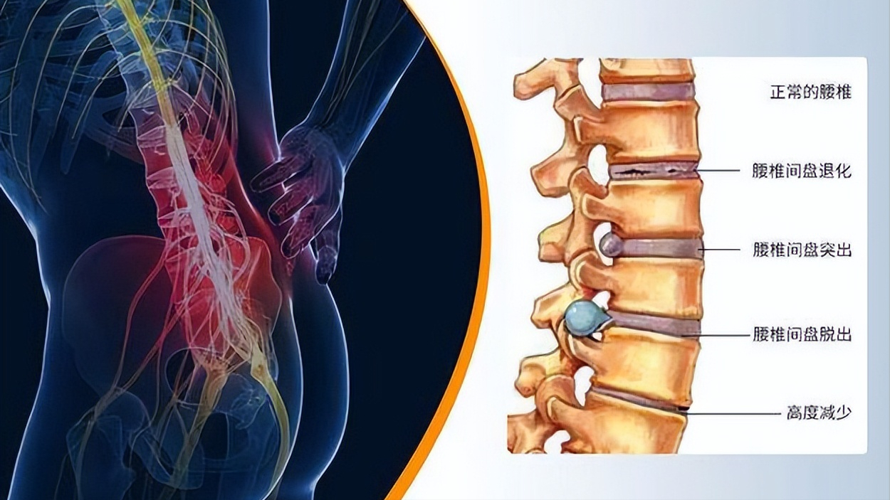 什么是腰椎间盘突出?