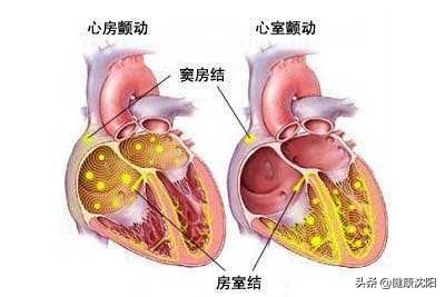 中国房颤日 | 关于“房颤”，你想知道的都在这里