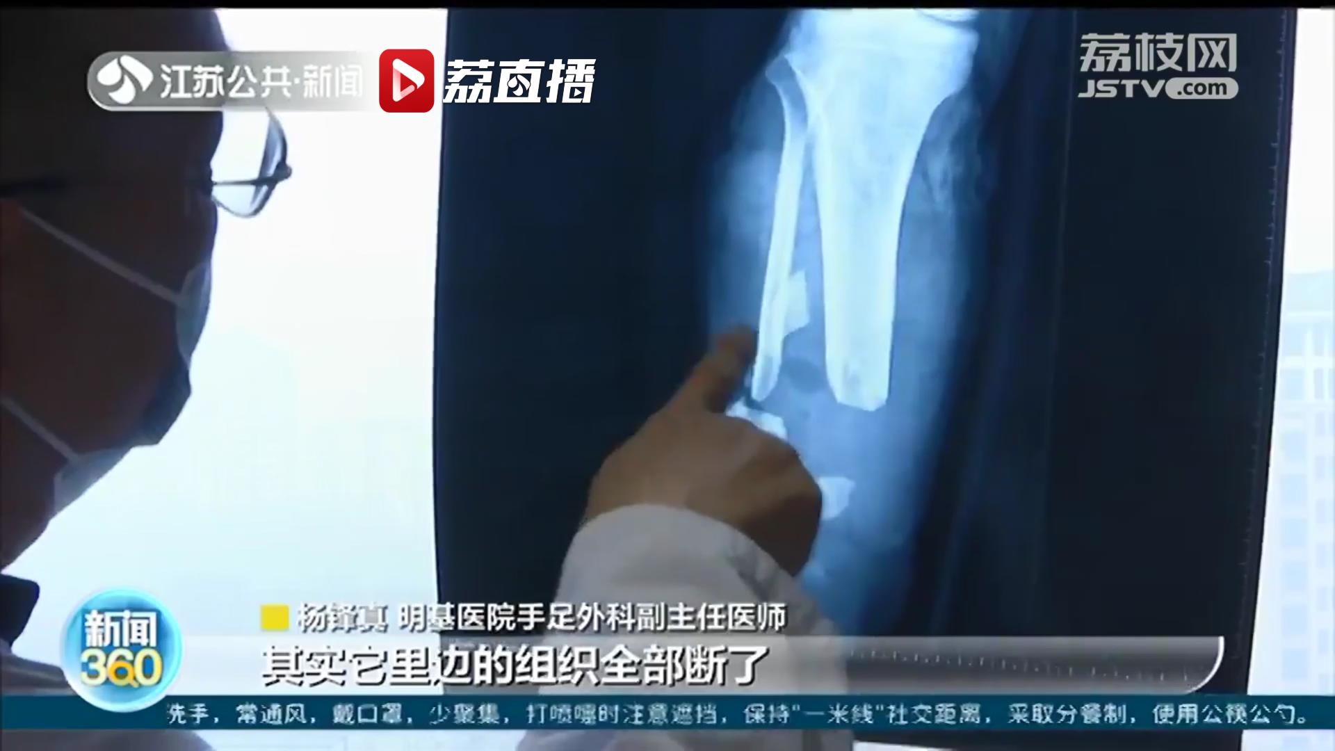保住了！男子高空作业小腿不慎被勒断 医院全力救治再植成活