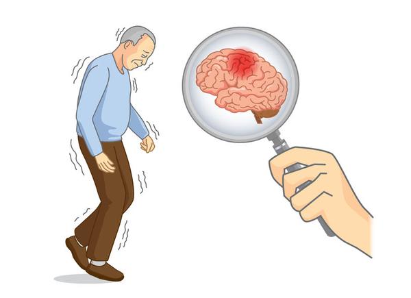 身体出现这5种迹象，当心是脑中风已“找上门”，及时检查不能拖