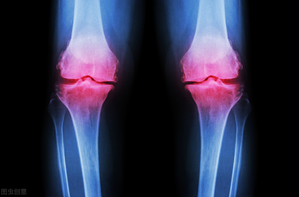 一個動作自測膝關節損耗？ 5種行為讓膝蓋過勞！ 你可能正在做