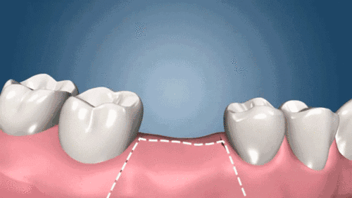 种植牙详细步骤图解(种植牙的流程有哪些？分为一二三期？)