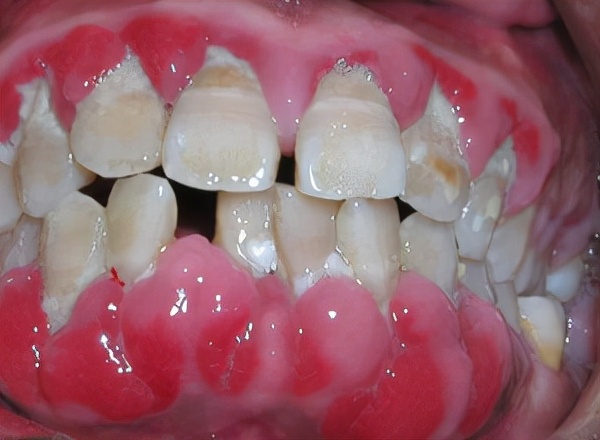 牙龈萎缩图片 初期图片