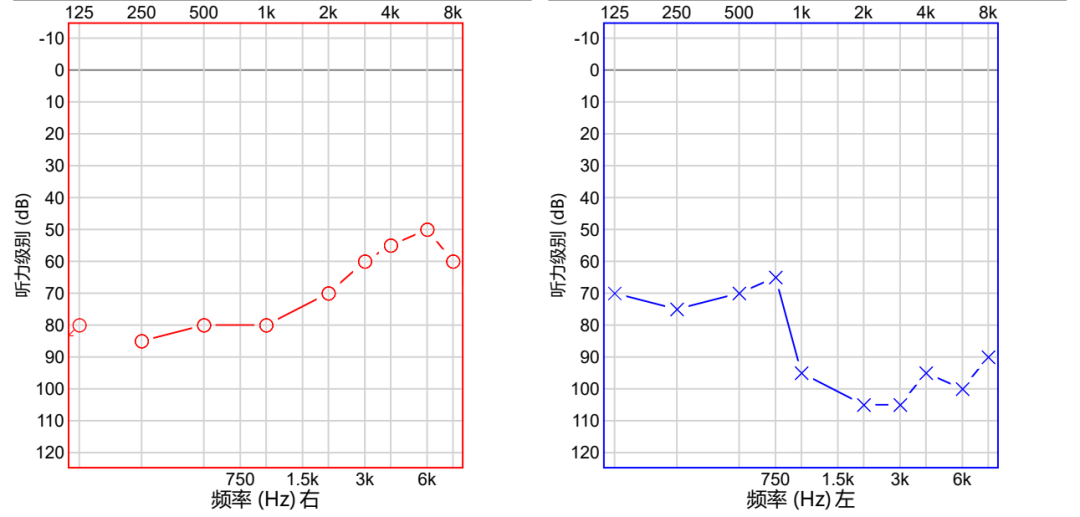 聆听幸福，传递温暖 | 爱心接力，听觉有道为小渝佳插上聆听的翅膀