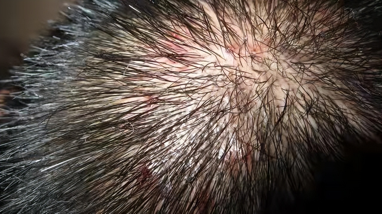 婴儿头皮毛囊炎夏天来了