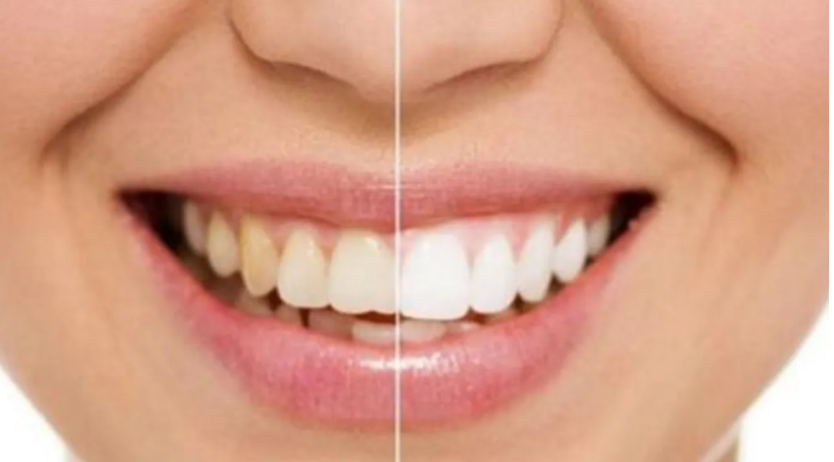 牙齒發黃的原因7個讓牙齒發黃的因素你知道幾個