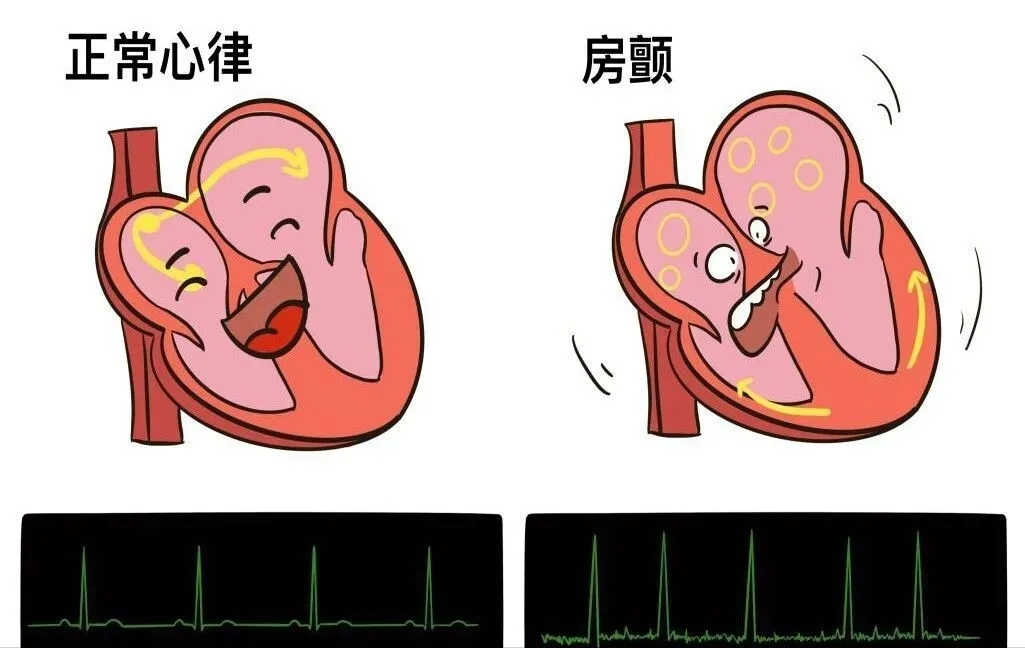 房颤患者可以做骨科手术吗？答案在这里