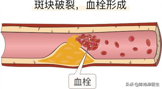 心梗急救，用丹参滴丸能起作用吗？医生：2种药物才是心梗适用药