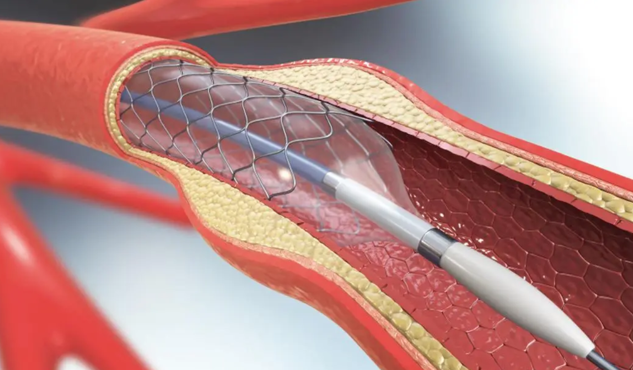 67心脏支架手术好坏:是救人还是"缺德害人"?做了能活多久?