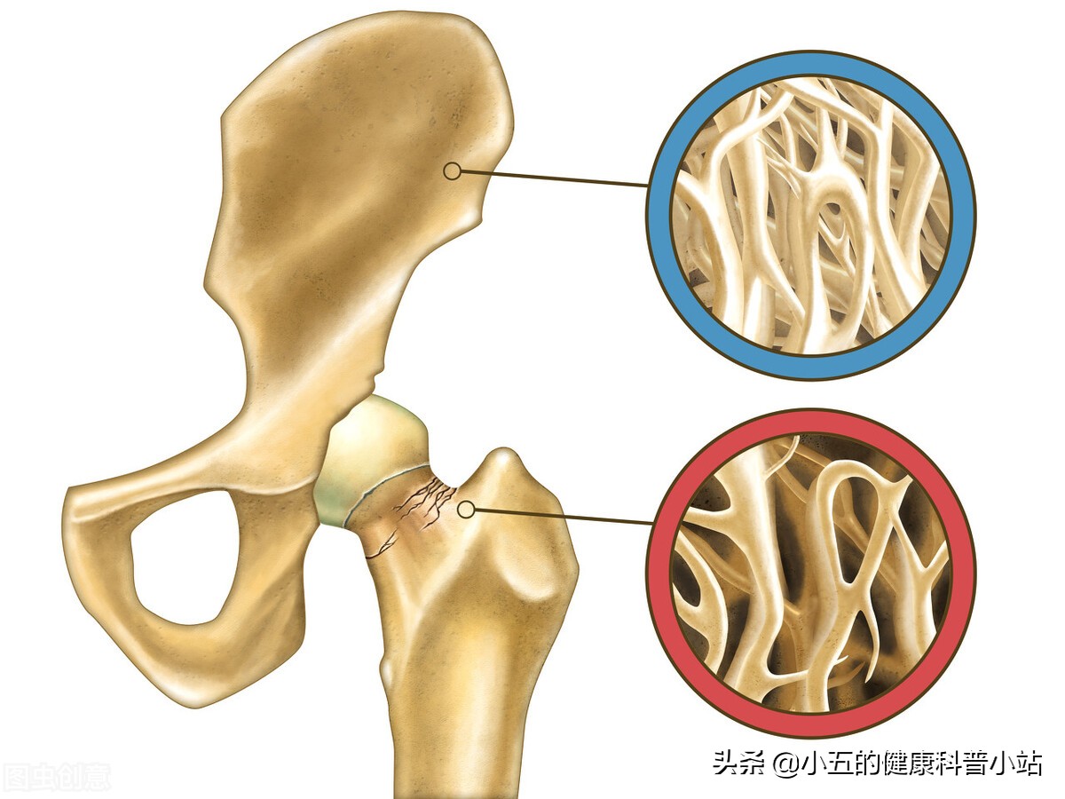 阿仑膦酸钠片是治疗绝经后骨质疏松症的常用药，科学服用注意4点