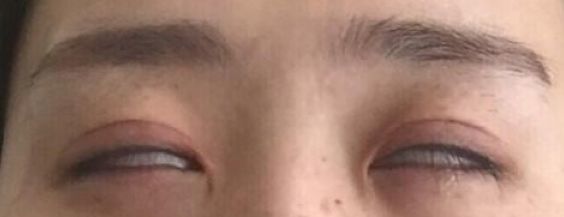 睑裂闭合不全——兔眼症