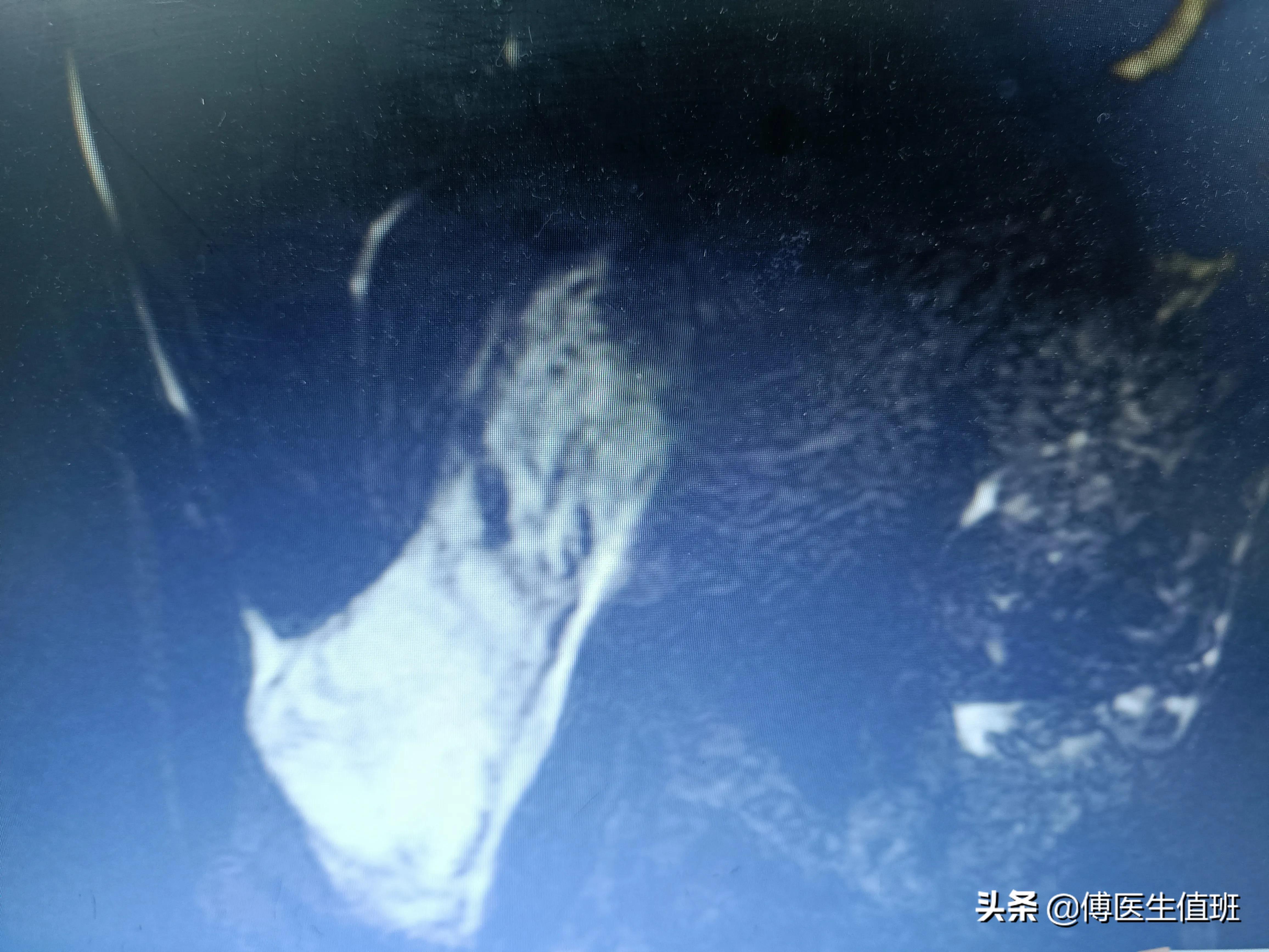 男子除夕酒后腹痛，急诊手术：大量恶臭脓液流出，误诊了？