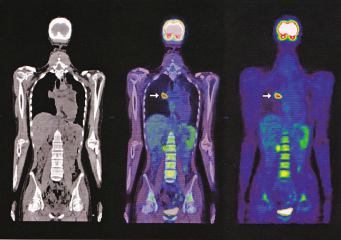 近万元的“查癌神器”PET-CT好在哪？为何医生不建议做？答案在这