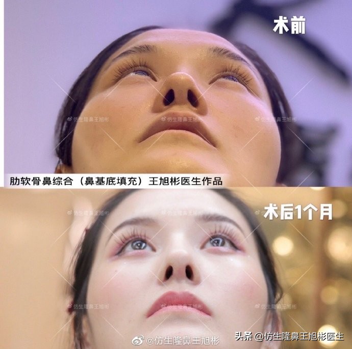 广州隆鼻科普：王旭彬鼻整形修复案例分享