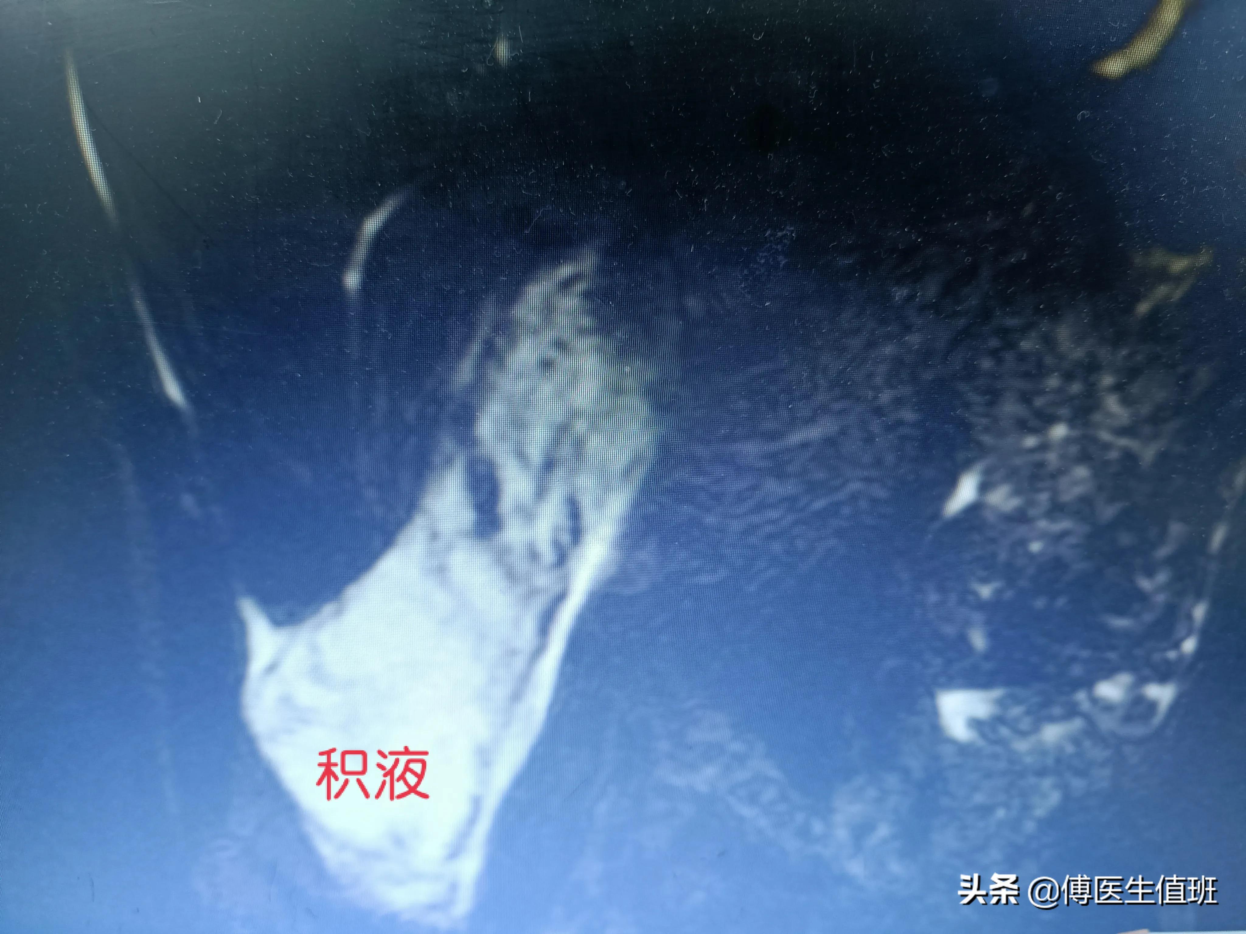 男子除夕酒后腹痛，急诊手术：大量恶臭脓液流出，误诊了？