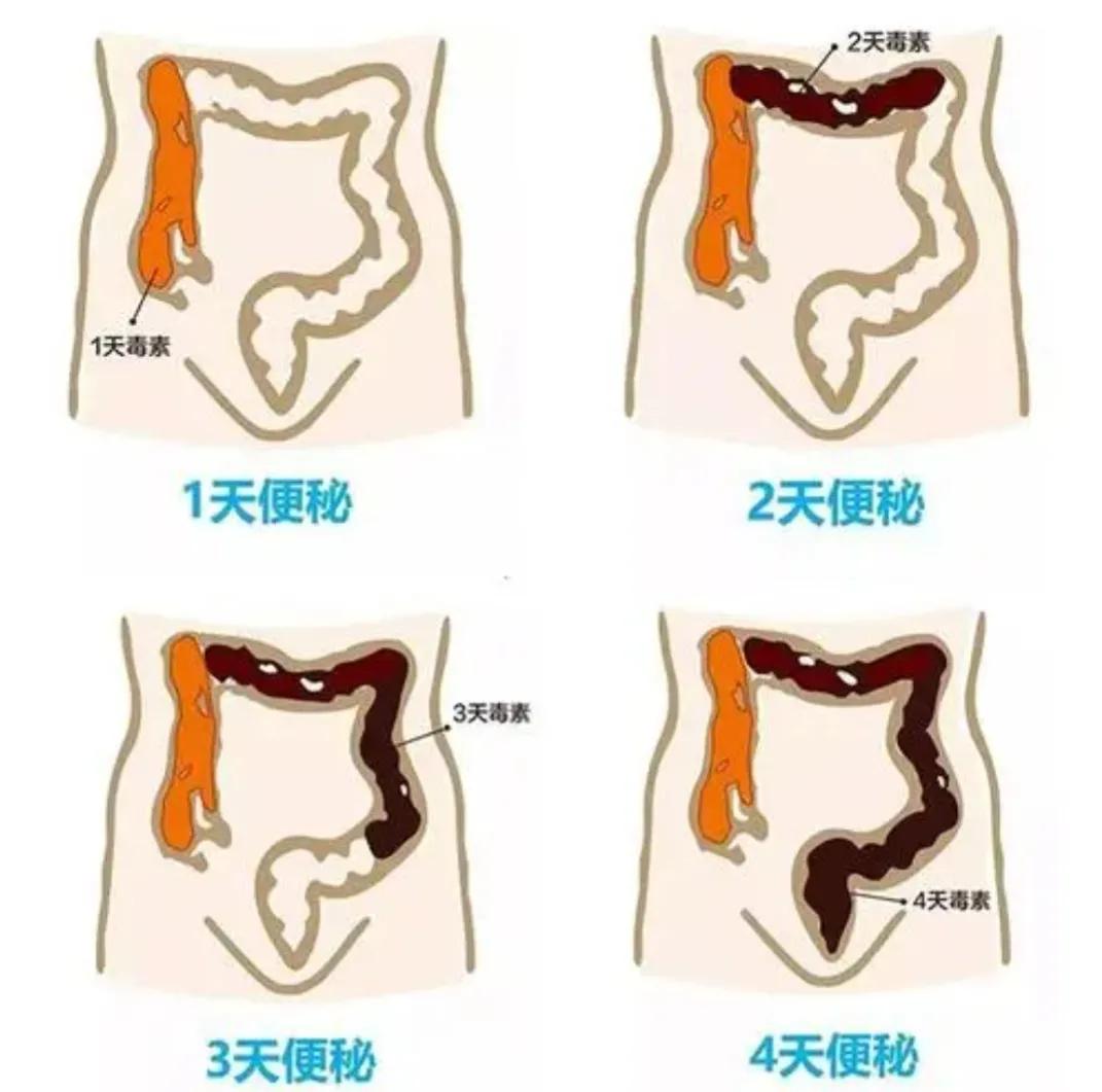 6大原因造成便秘，医生：长期便秘疾病多，老人严重的会猝死