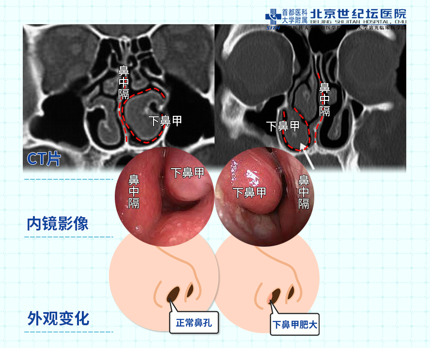 它由表面的黏膜和内部的骨质构成,从鼻腔的外侧向内部突出,这种向内突