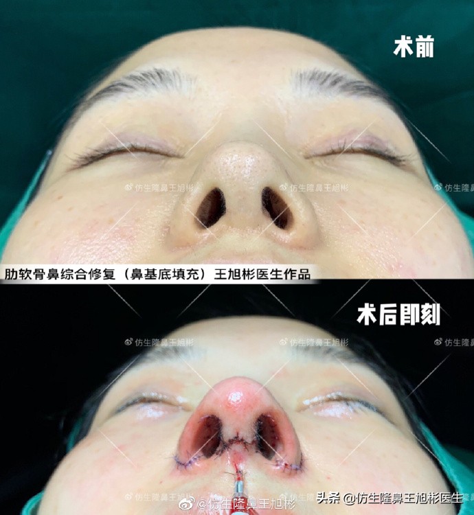 广州隆鼻科普：王旭彬鼻整形修复案例分享