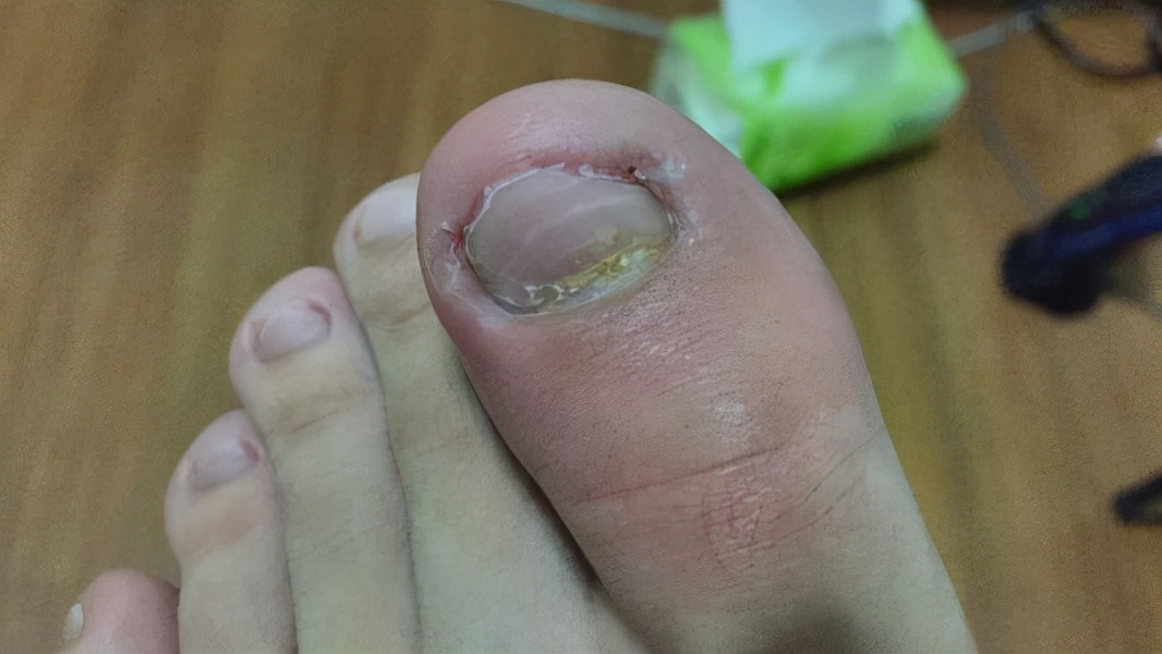 手指甲为什么会出现“竖纹”？指甲常出现的几个问题，建议了解下