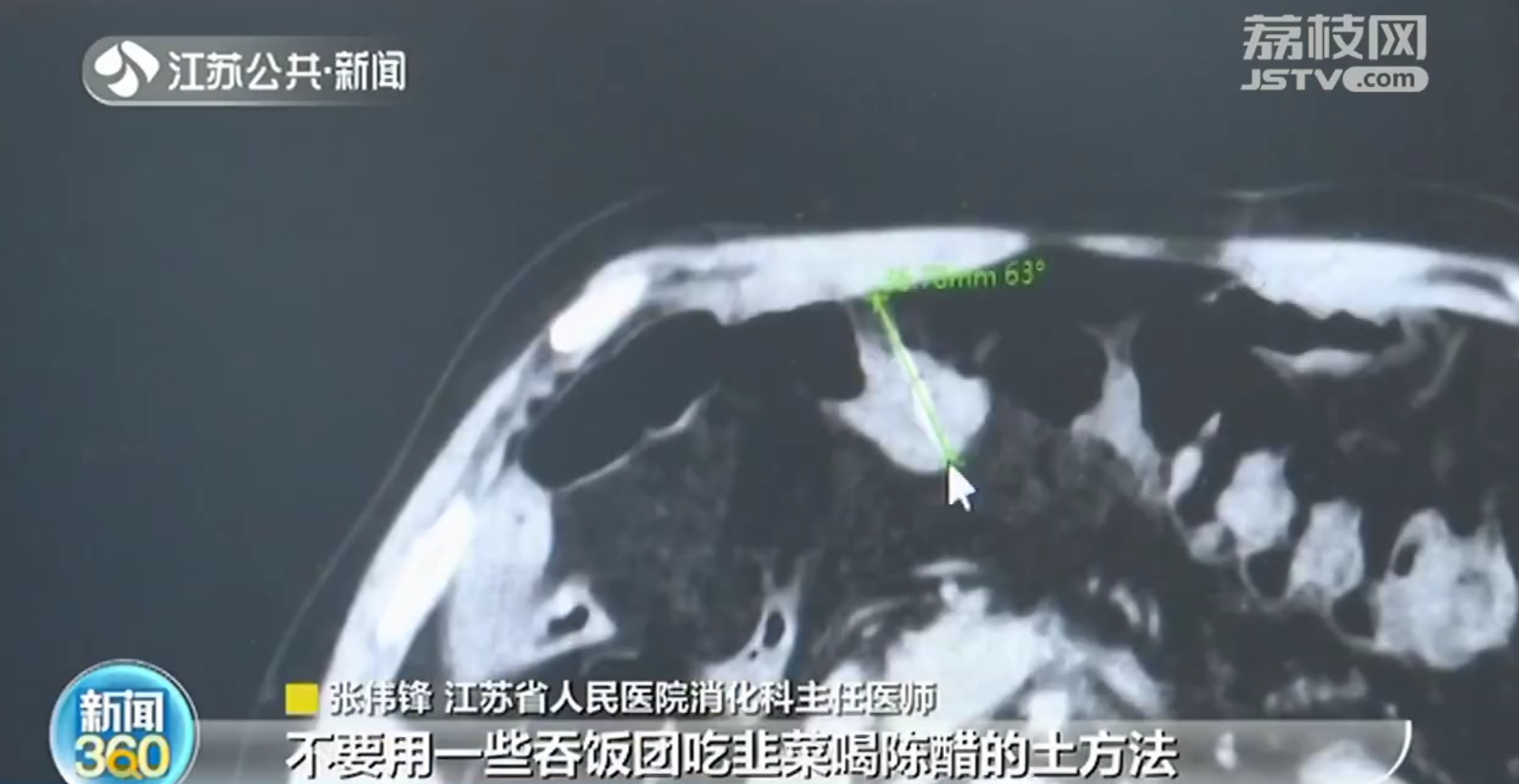 南京：91岁老人鸡骨卡喉 用&ldquo;土办法&rdquo;吞饭团显酿悲剧