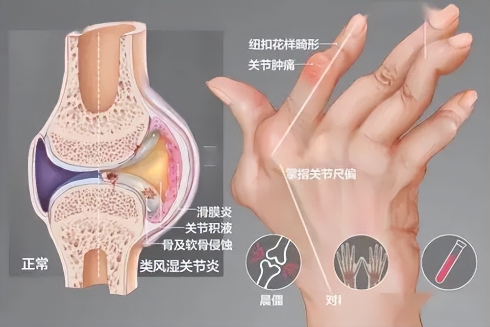 手指骨质增生图片(老年人手指僵硬) - 赤虎壹号