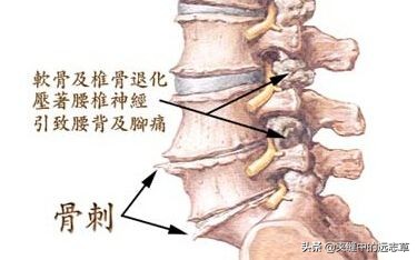 骨质增生，骨刺？讲一剂中成药，阴阳双补，调和肝肾，兼可止痛