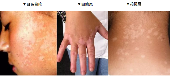 身上长白斑,不一定是白色糠疹,还可能是以下皮肤病,要注意区分症状