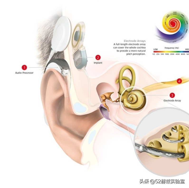 进口人工耳蜗要30万？国产货硬气说不，打破国外垄断