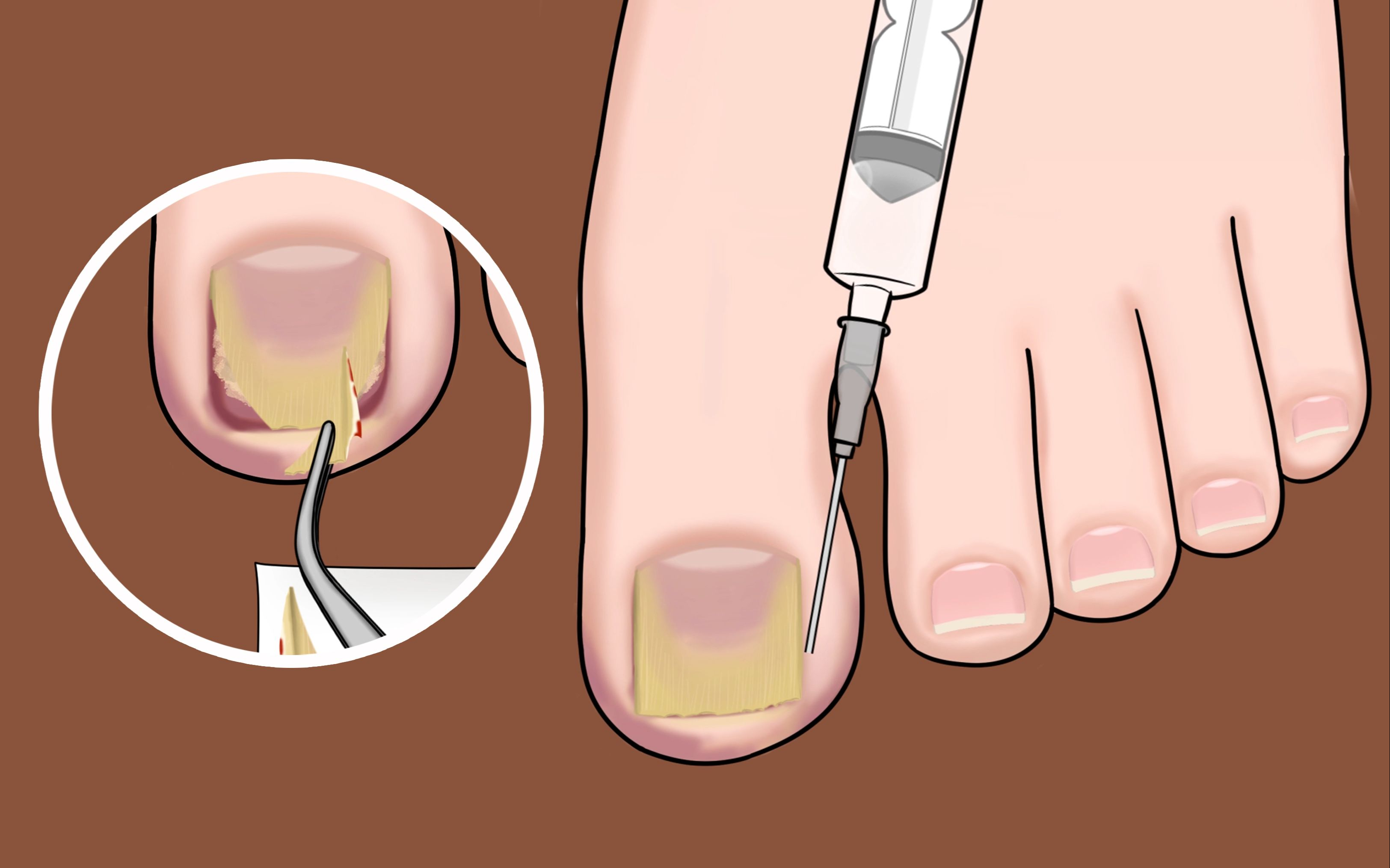 得了甲沟炎怎么治(趾甲老往肉里钻) - seo葵花宝典