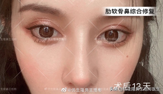 广州隆鼻科普：王旭彬鼻整形修复案例分享