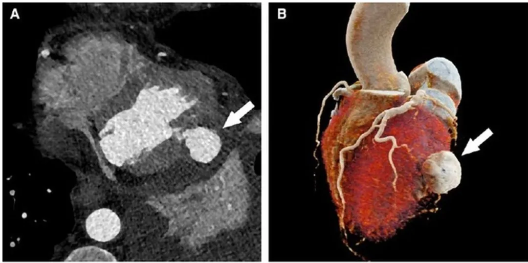 心脏上长出的“气球”：心脏室壁瘤你了解吗