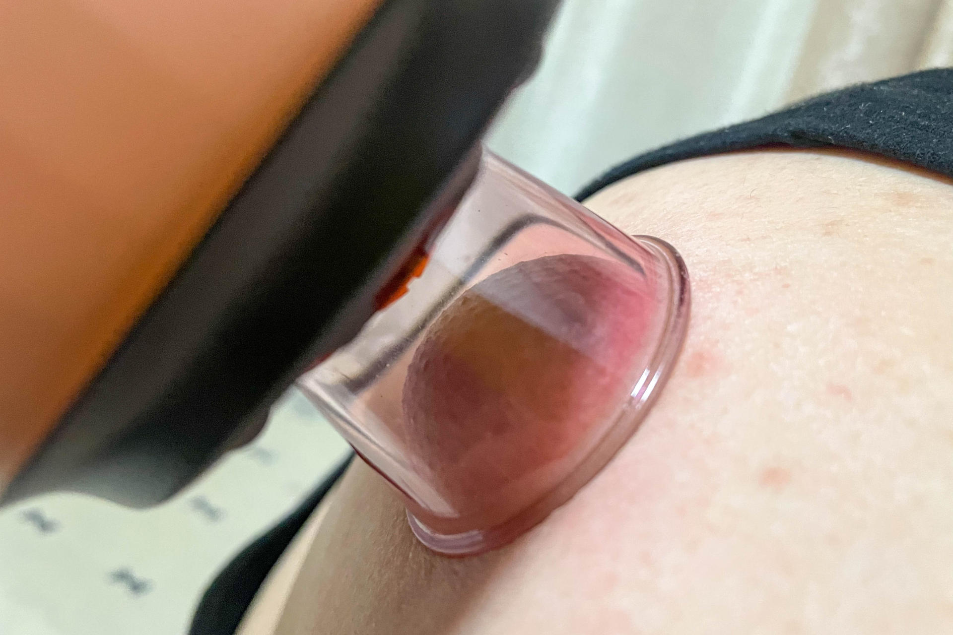 拔罐也要科技化！拔罐+走罐，让设备精准保健