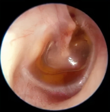 「爱耳日」市中心医院耳科来答疑释惑①恼人的分泌性中耳炎