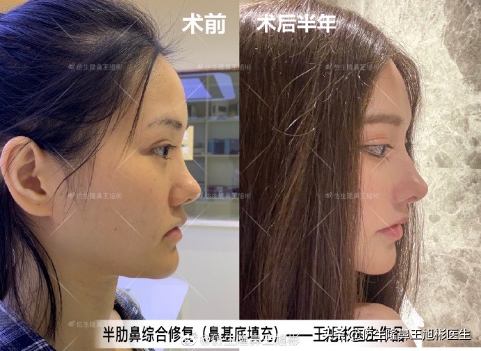 广州隆鼻科普：王旭彬鼻整形修复案例分享