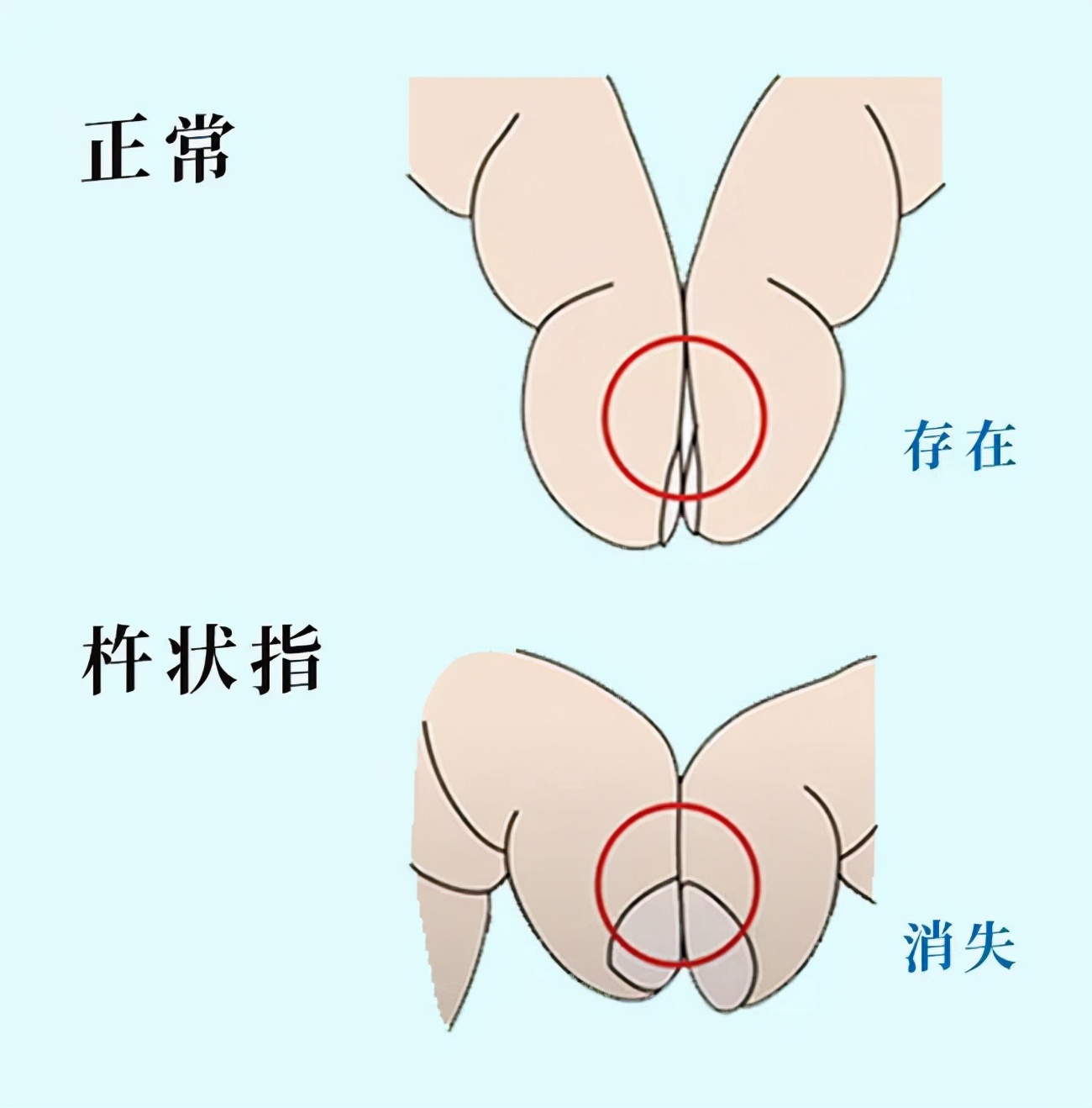 从手指也能看出肺癌？提醒：手指出现5个异常，赶紧排查病因