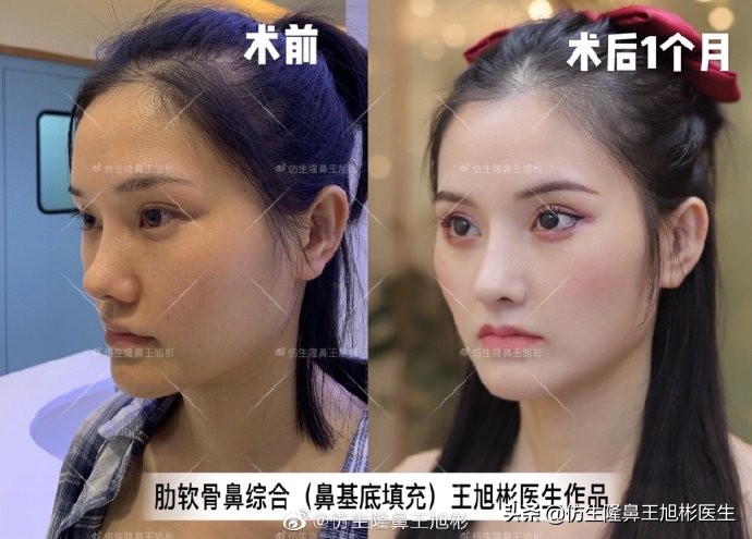 广州隆鼻科普：王旭彬鼻整形修复案例分享