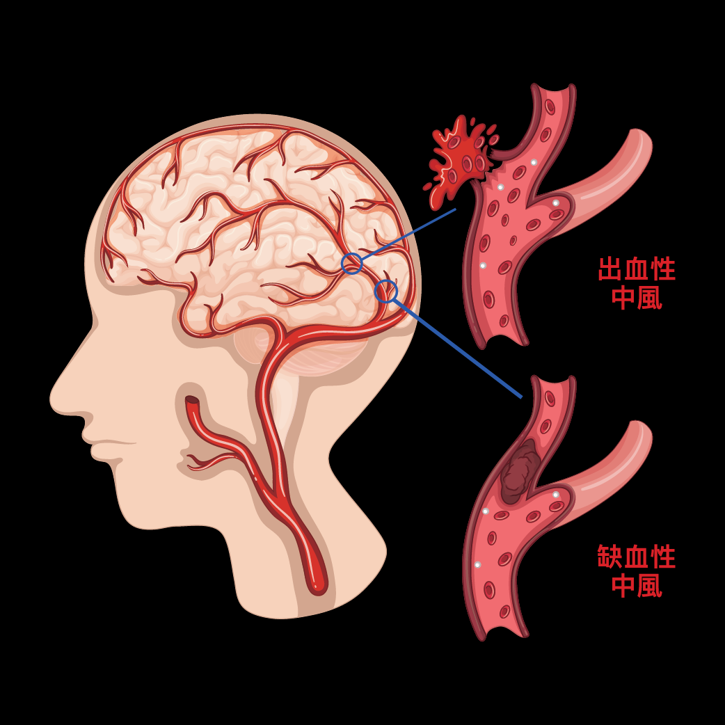 脑梗的症状都有哪些前期症状(无端端出现8种表现,很有可能是脑梗"求救