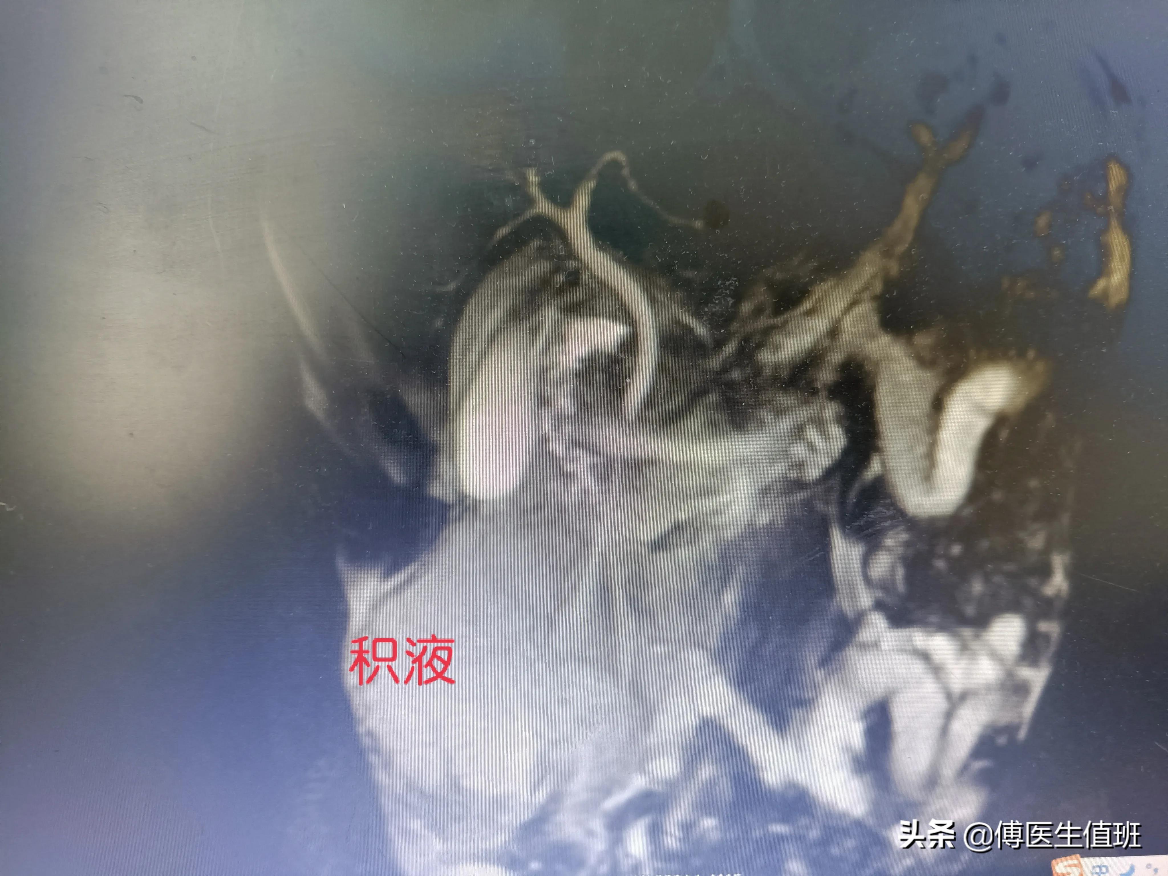 男子除夕酒后腹痛，急诊手术：大量恶臭脓液流出，误诊了？